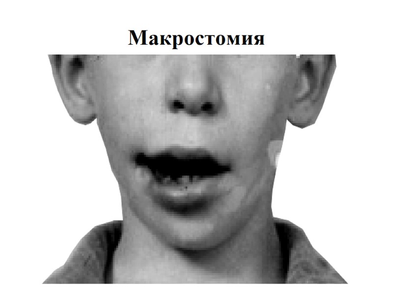 Макростомия